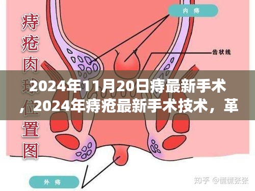 革新与未来展望，2024年痔疮最新手术技术及展望